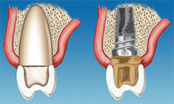 Gum disease